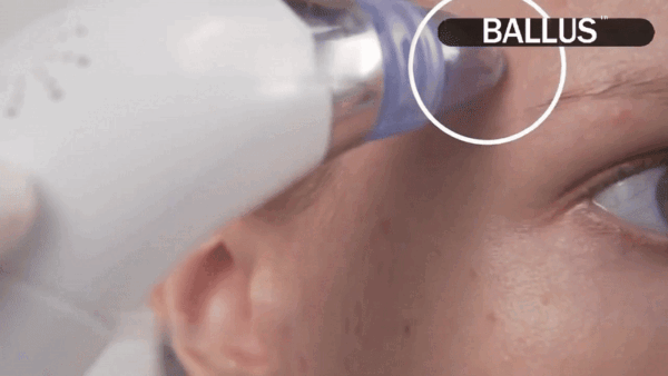 Pore Cleaning Device video